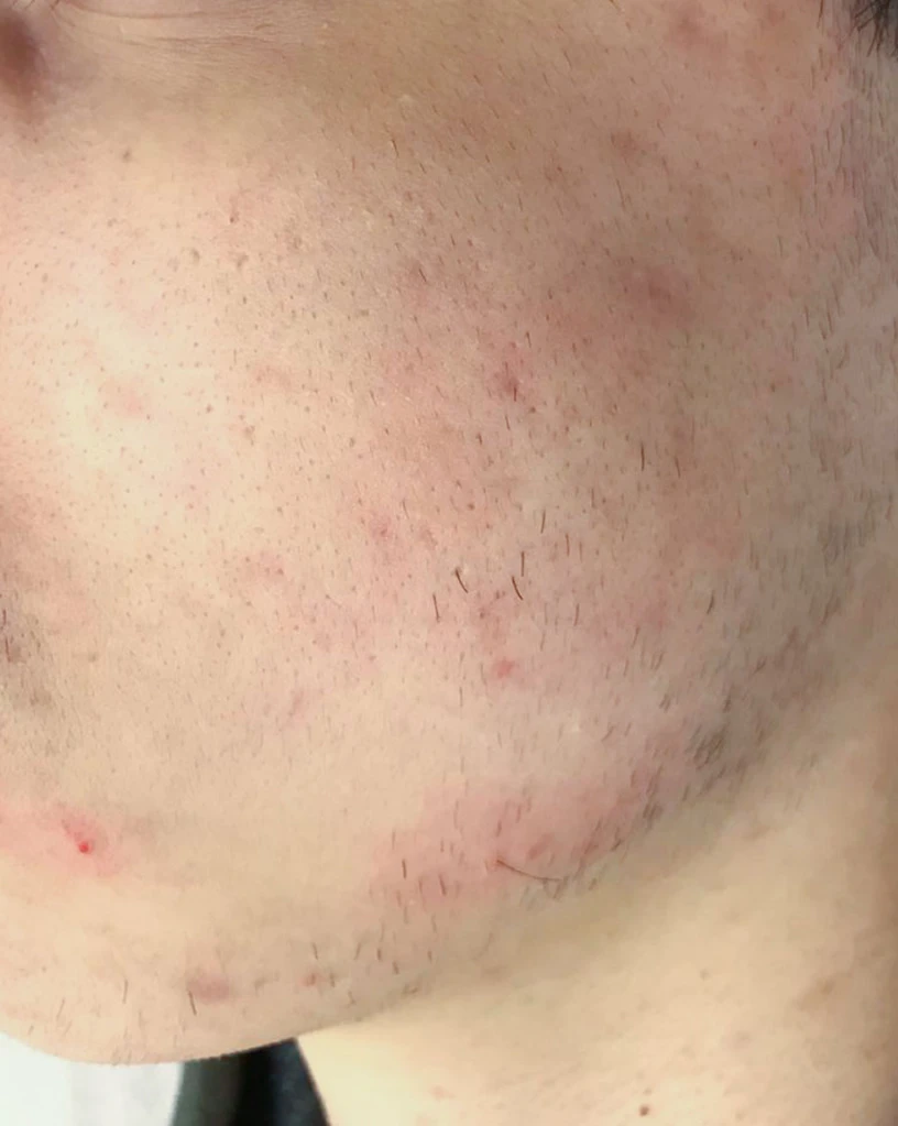 BBL BroadBand Light Acne