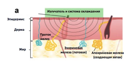 лечение гипергидроза на аппарате MiraDry