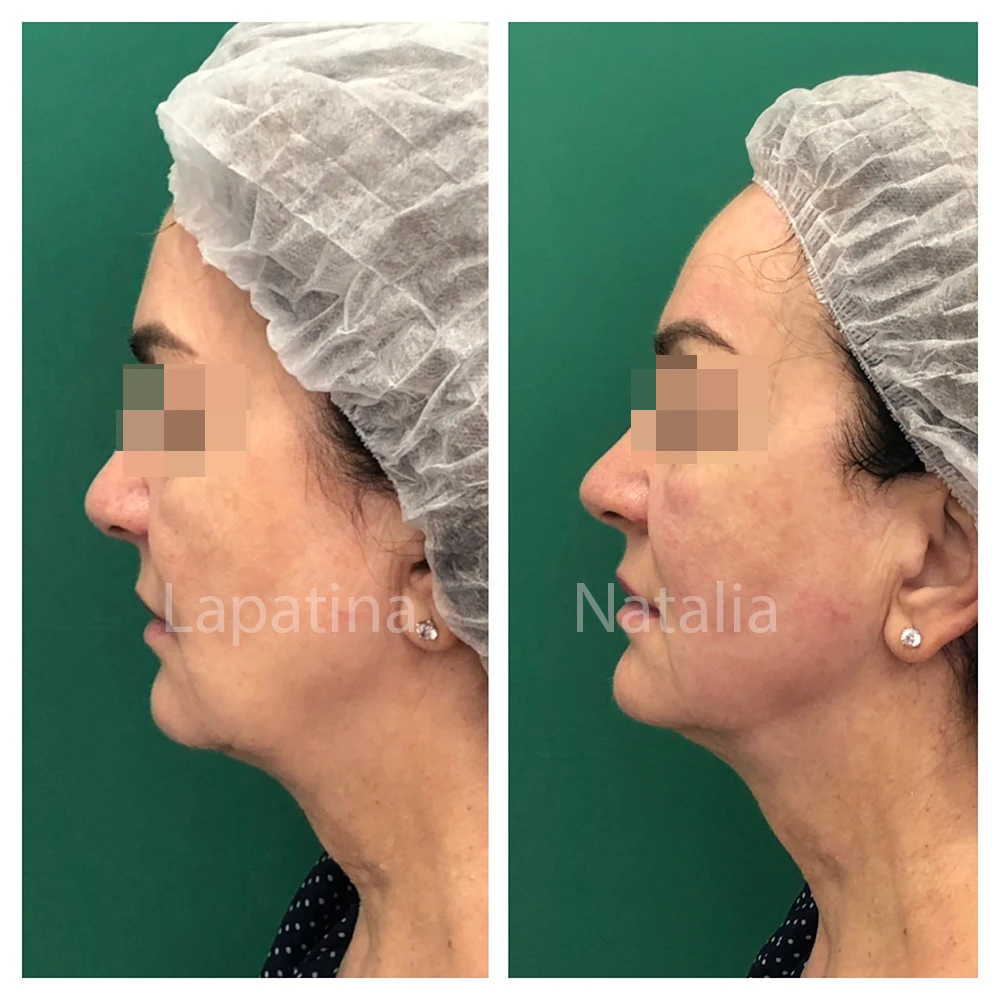 Альтера-терапия, Ultherapy, фото до и после