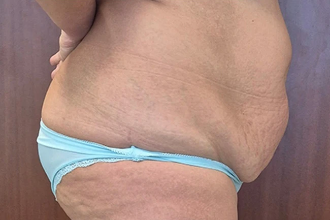 До, криолиполиз CoolShaping 2