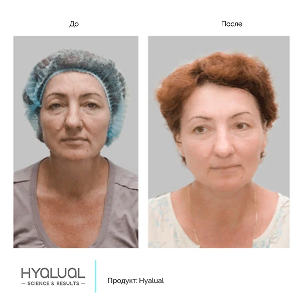 Hyalual 2,2 %, фото до и после