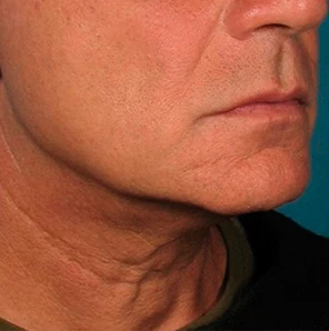 Фото после процедуры Ultherapy