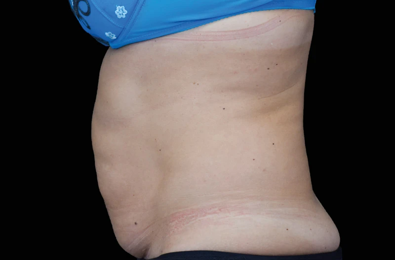 Фото до процедур на аппарате EMSCULPT