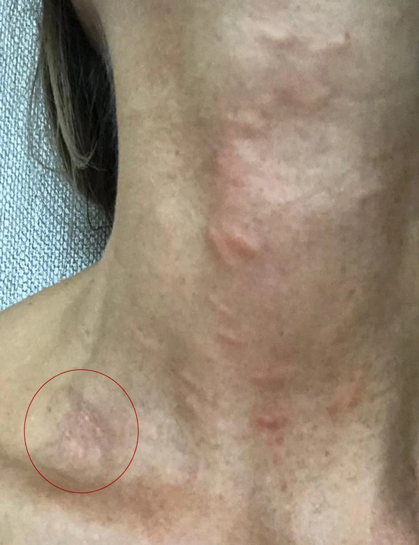 Очаговая атрофия кожи