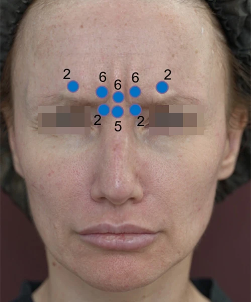 Коррекция препаратом Belotero