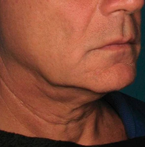 Фото до процедуры Ultherapy