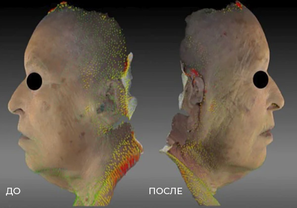 заднетемпоральный лифтинг