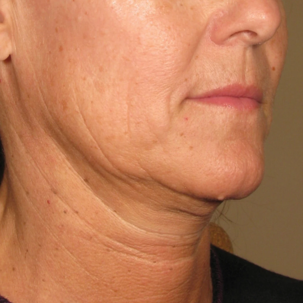 Ultherapy До