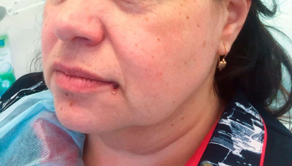 Применение Ultherapy