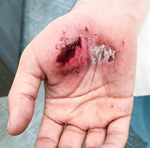 EpiDermG до применения