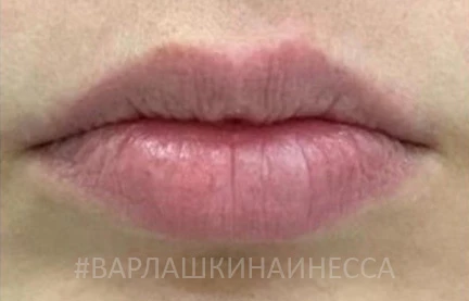 Коррекция губ филлером Etermis 4, фото До