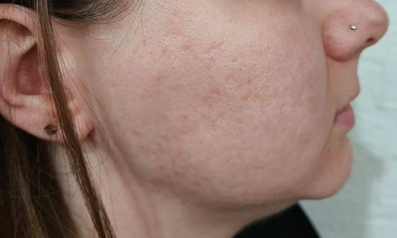 Комбинация пилинга B-Twin System и PRP Cellenis