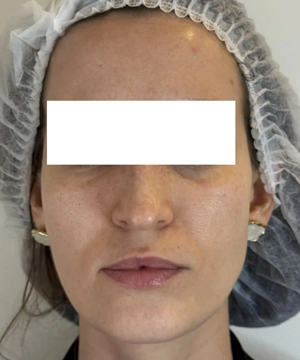 Alma Hybrid, фото до