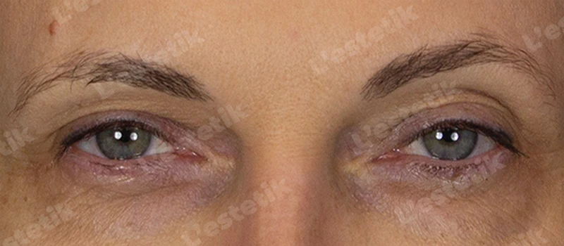 RF-лифтинг Ashley, фото До