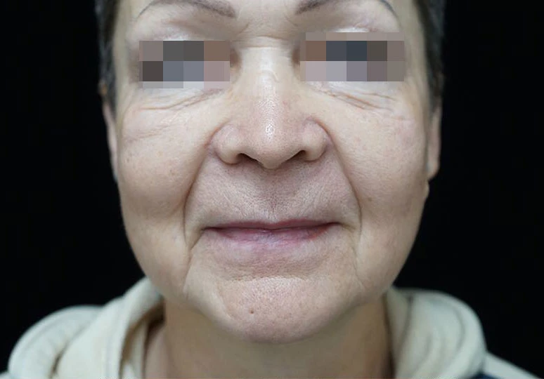 Сочетанное применение Ultherapy и инъекционной коррекции