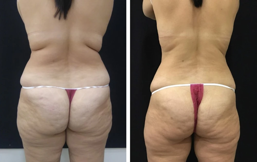 коррекция на аппарате Clatuu, фото до и после