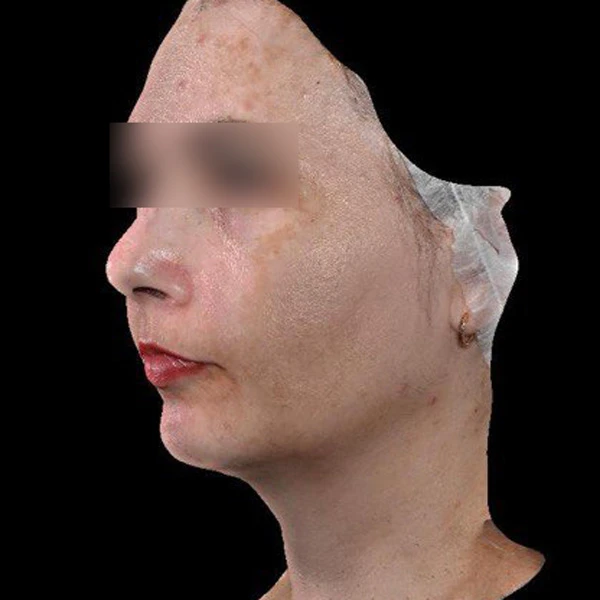 Лазерное лечение гиперпигментации: фото до