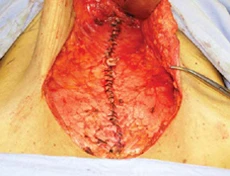 расхождение прямых мышц живота