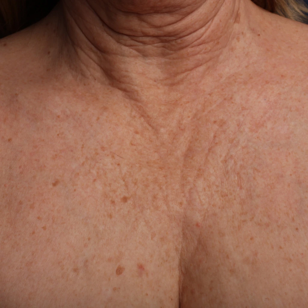 Ultherapy До