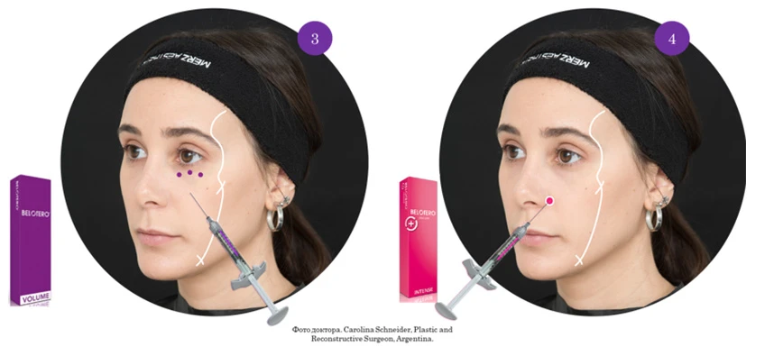 Техника В.UP филлерами Belotero