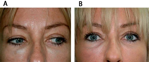 Препараты гиалуронидазы