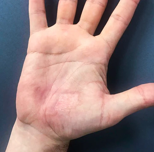EpiDermG после применения