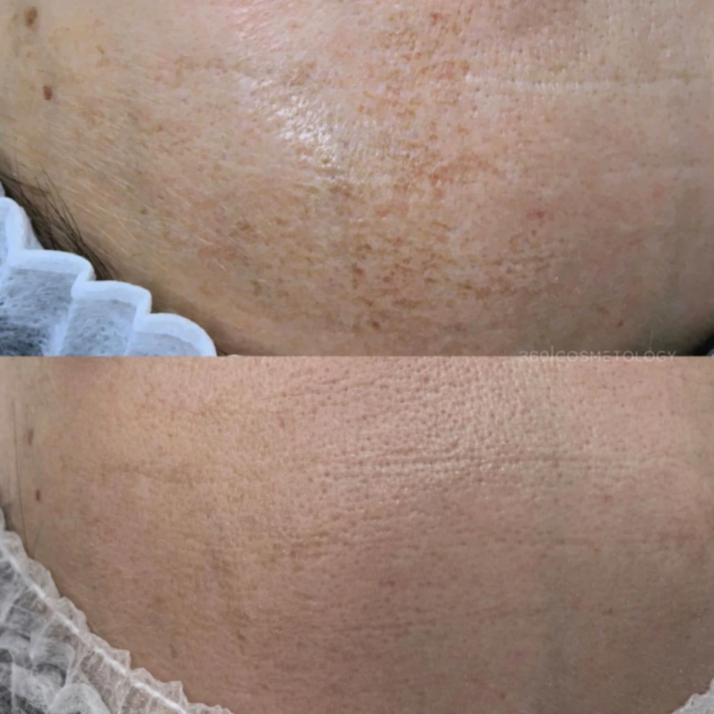 терапия HELEO4™