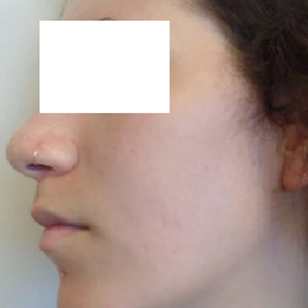 Harmony XL Pro, фото после