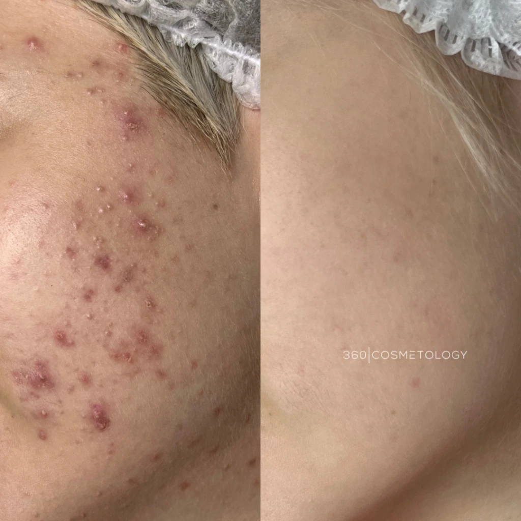 терапия HELEO4™