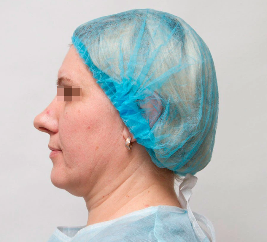 Применение Ultherapy