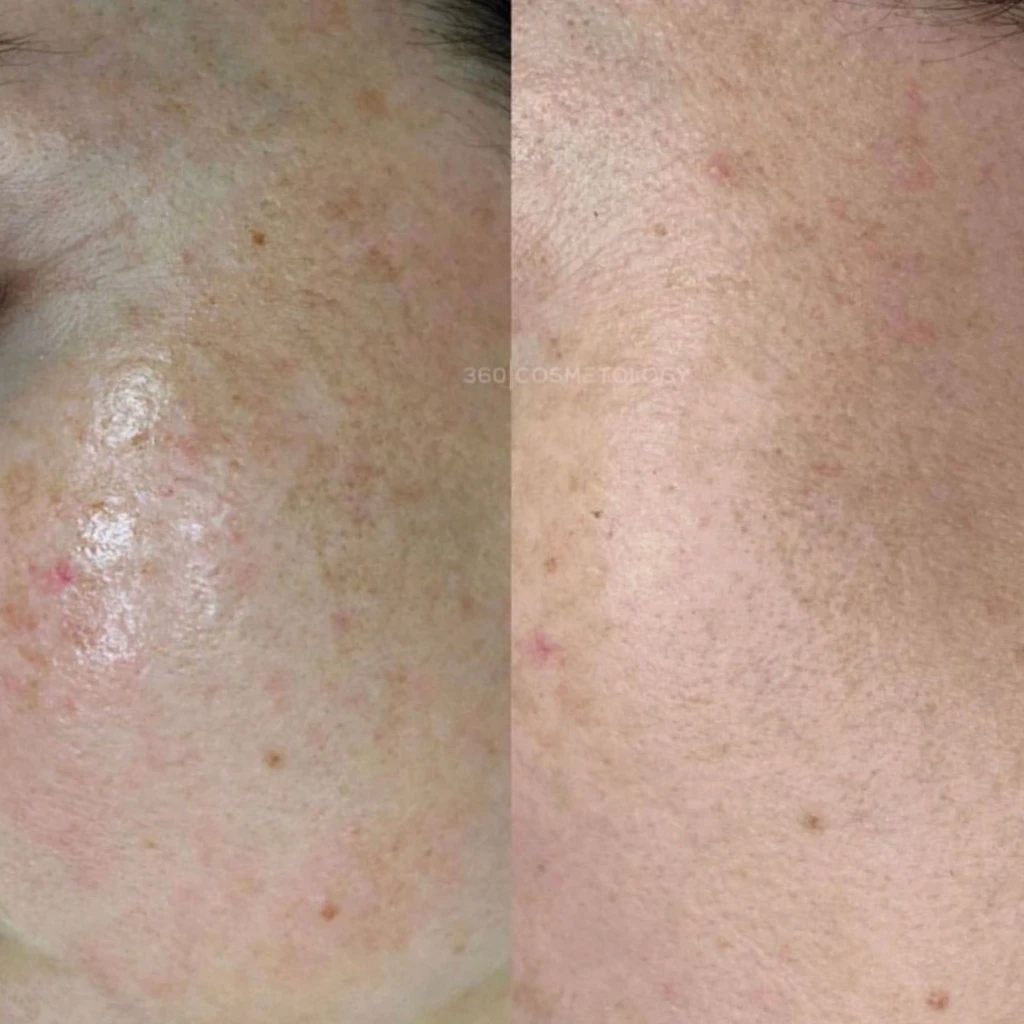 терапия HELEO4™