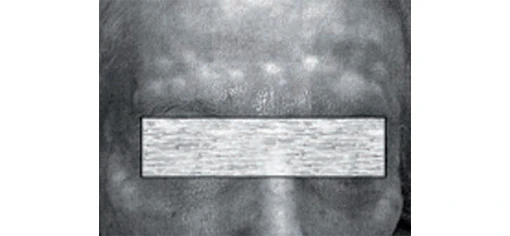 Препараты гиалуронидазы