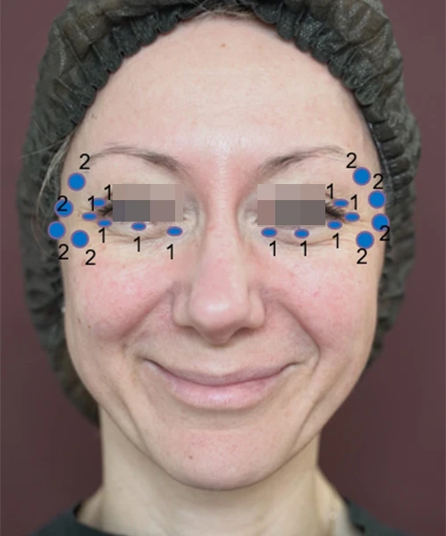 Разметка для инъецирования Ксеомин