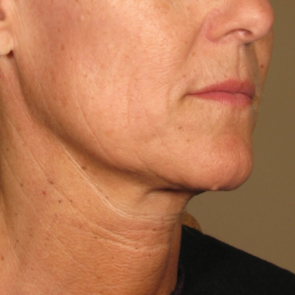 Ultherapy После