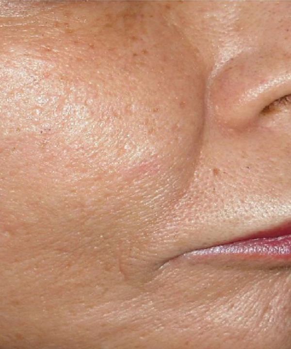 Harmony XL Pro, фото после