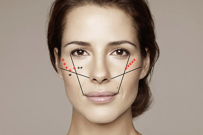 скуловая область, разметка, Restylane Perlane