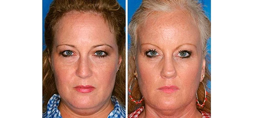  Однояйцевые близнецы