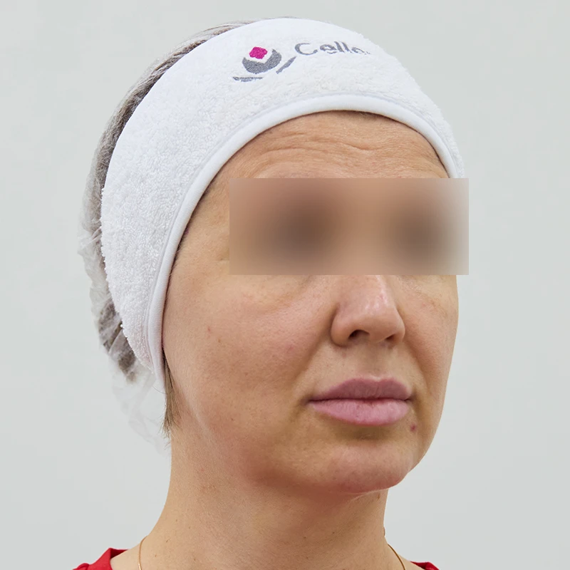 Neauvia и Cellenis PRP