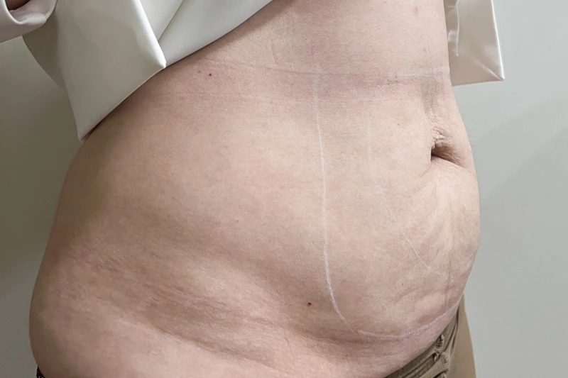 Комбинированный протокол Ulfit + Volnewmer, фото до