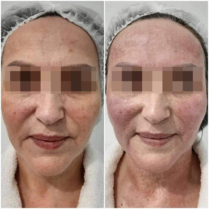 Hyalual 2,2 % и Perfoskin Complex. Фото до и после