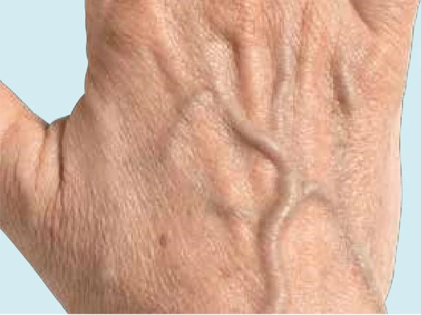 Коррекция зоны рук филлером Radiesse