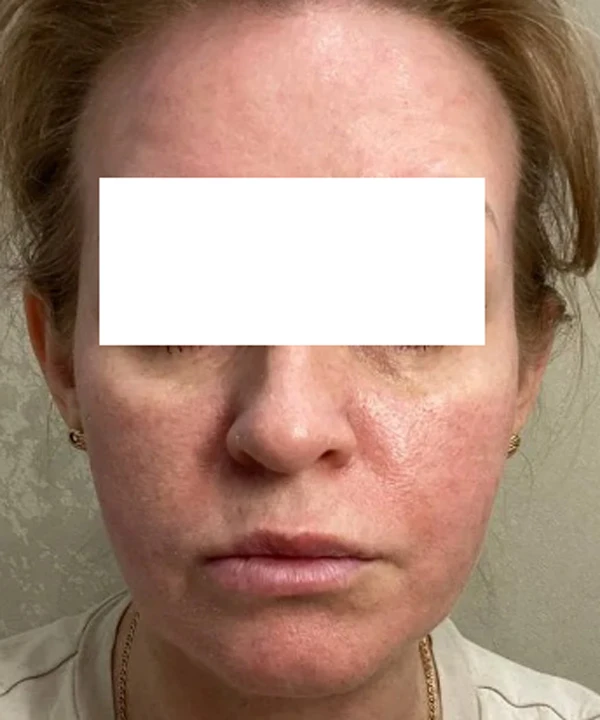 Alma Hybrid, фото после