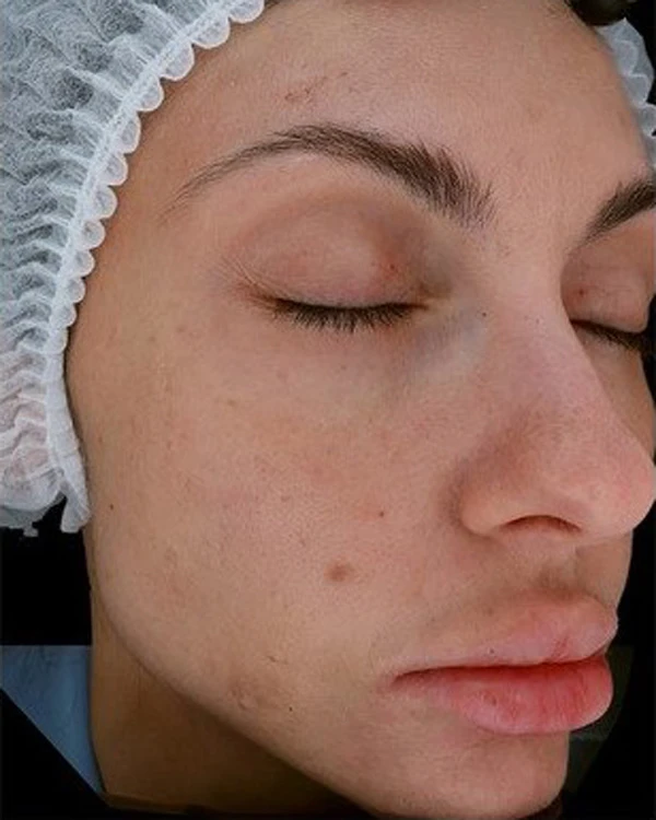 Calecim Professional Serum