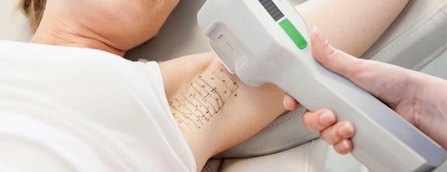 Гипергидроз лечение