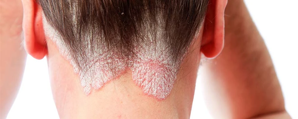 Псориаз волосистой части головы