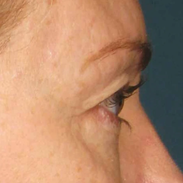 Ulthera System фото до и после