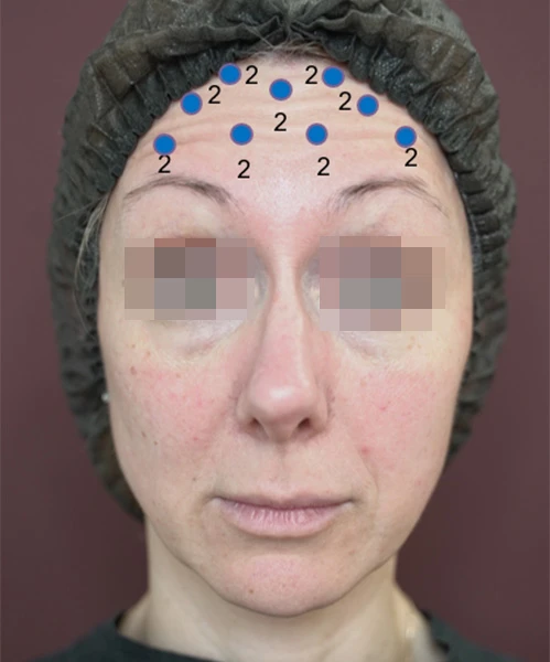 Разметка для инъецирования Ксеомин