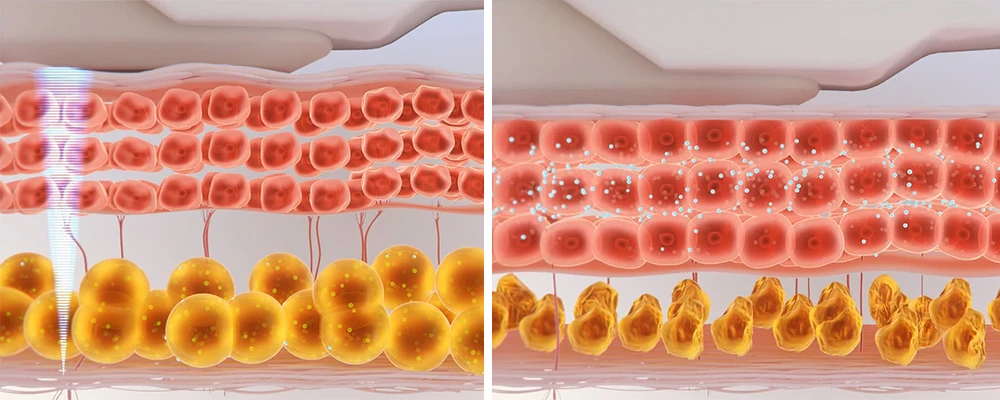 HIFU Высокоинтенсивный сфокусированный ультразвук