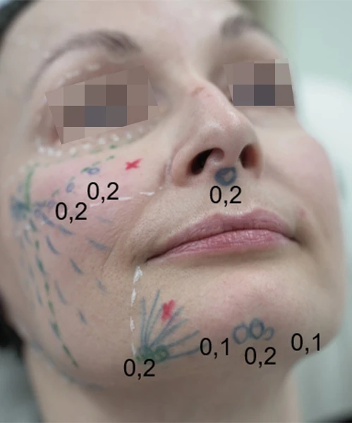 Разметка для инъецирования Radiesse