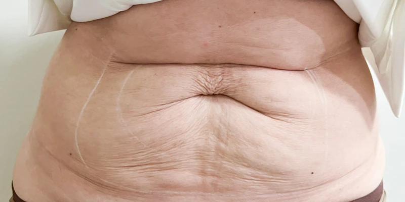 Комбинированный протокол Ulfit + Volnewmer, фото до